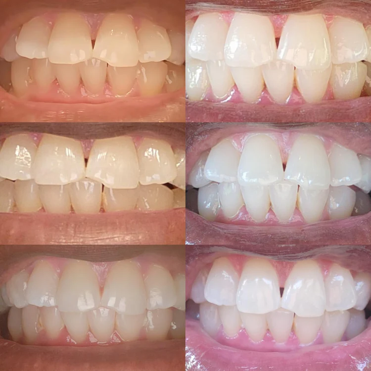 Extra-Strength Teeth Whitener Pen